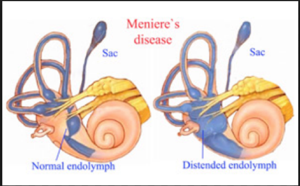Sindrome di Meniere idrope endolinfatico accenni . Andrea Rinciari